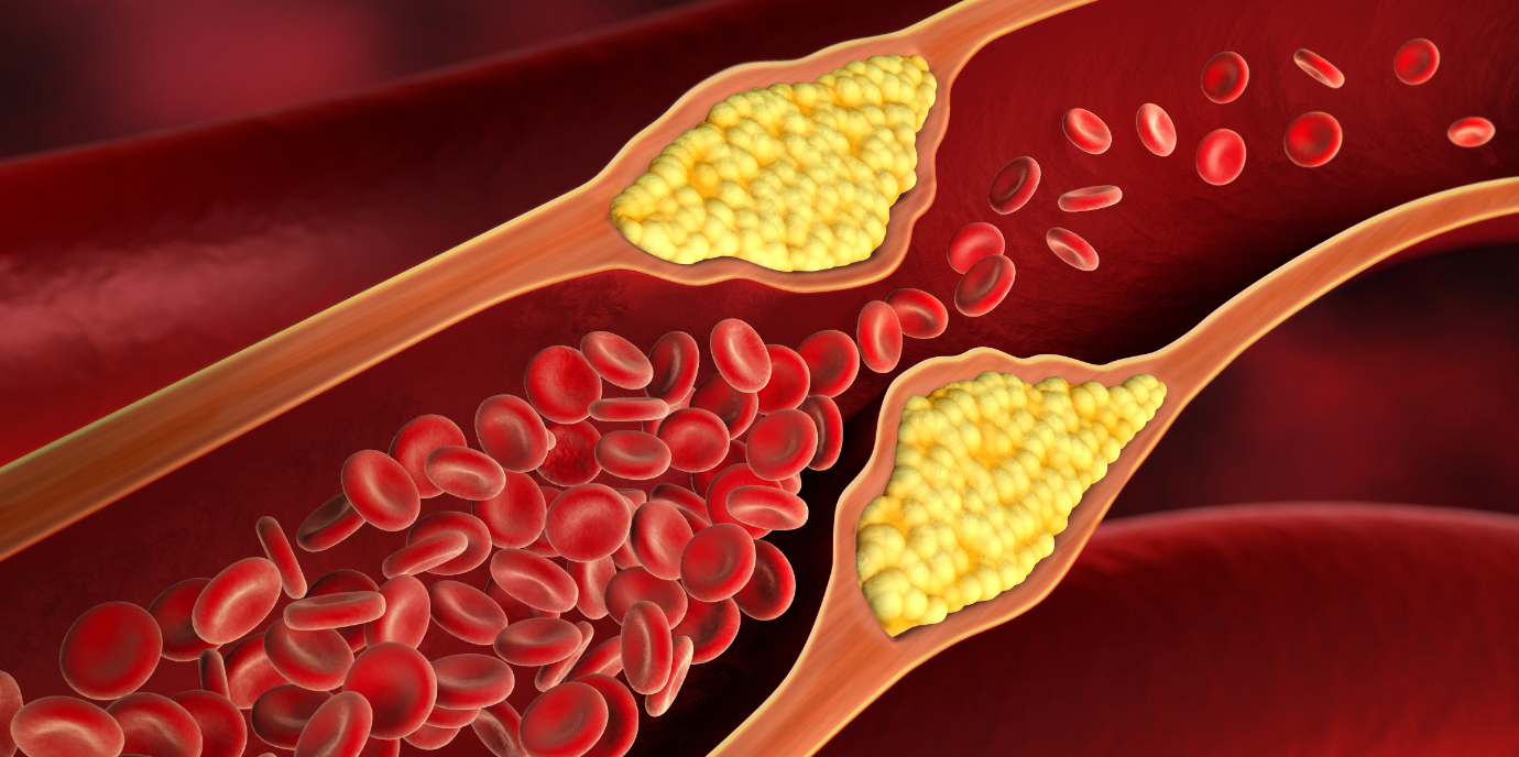 Dem „bösen“ Cholesterin auf der Spur