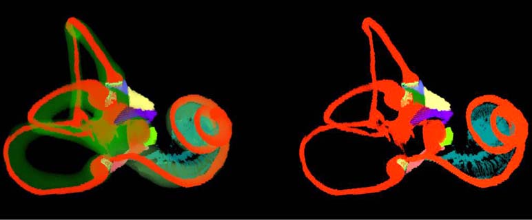 3 D Rekonstruktion des menschlichen Innenohres 