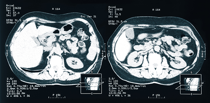 COVID-19: „Nature Reviews Nephrology“ beschreibt nephrologische Herausforderungen