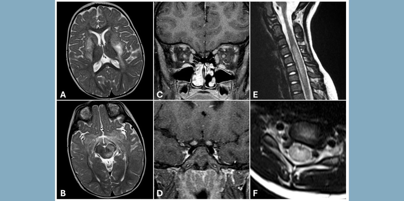 A20-Protein hilft, akuten Schub und Remission bei MOGAD zu unterscheiden