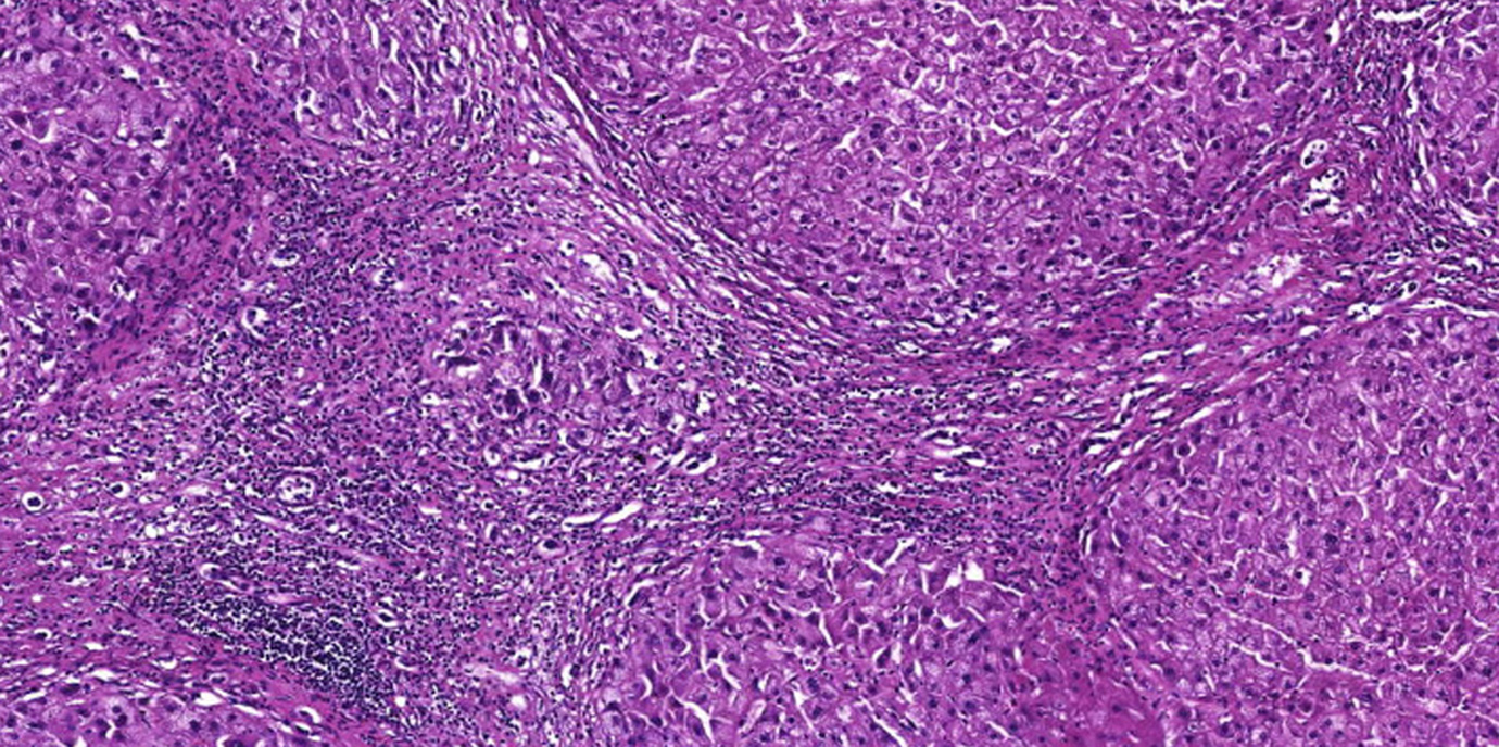 Fettleber-Epidemie: gesetzliche Maßnahmen gefordert
