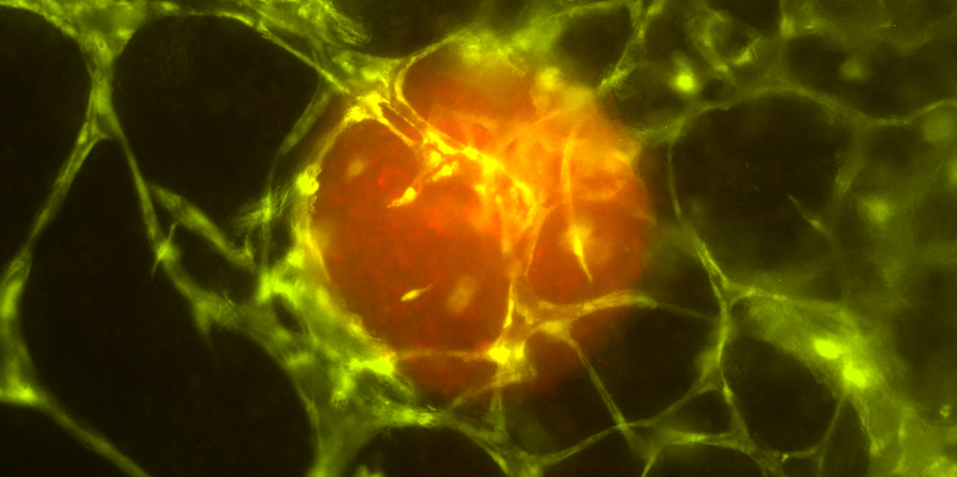 Dem Tumor beim Wachsen zusehen