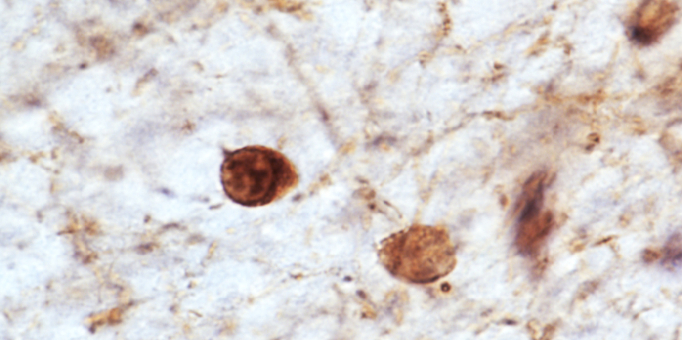 Vier neue genetische Risikofaktoren für MSA identifiziert