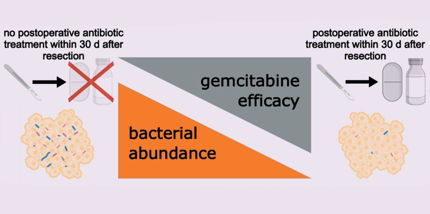 Antibiotika verlängerten das Leben von Patient:innen mit Bauchspeicheldrüsenkrebs
