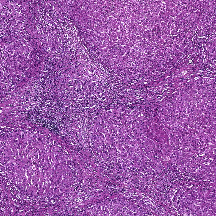 Wieser-et-al-ASH